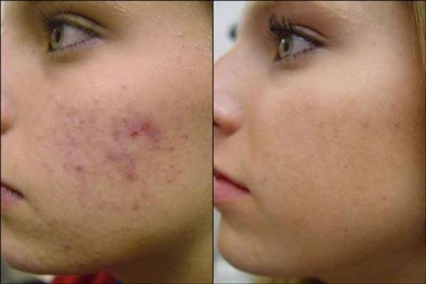 Microdermabrasion - bekanntes Verfahren in neuem Licht